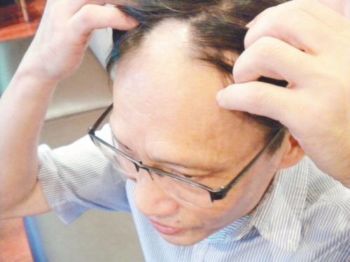 什么是拔毛癖？為什么一焦慮就拔頭發(fā)？