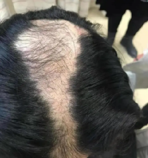 孩子咬手指至變形是什么心理？